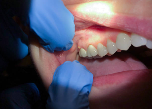 Best Emergency Broken Tooth Repair in Maysville, GA